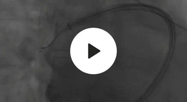 endovascular-engineering-anatomy-navigation-video