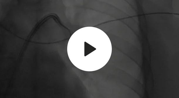 endovascular-engineering-clot-removal-video