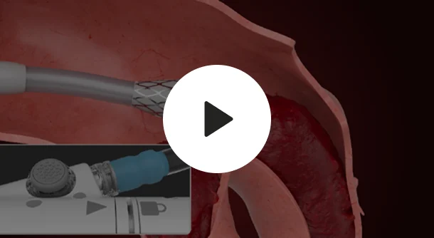 endovascular-engineering-product-overview-video